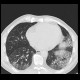 Lung fibrosis, HRCT: CT - Computed tomography